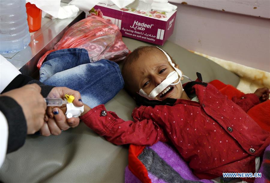 YEMEN-SANAA-CHILDREN-MALNUTRITION